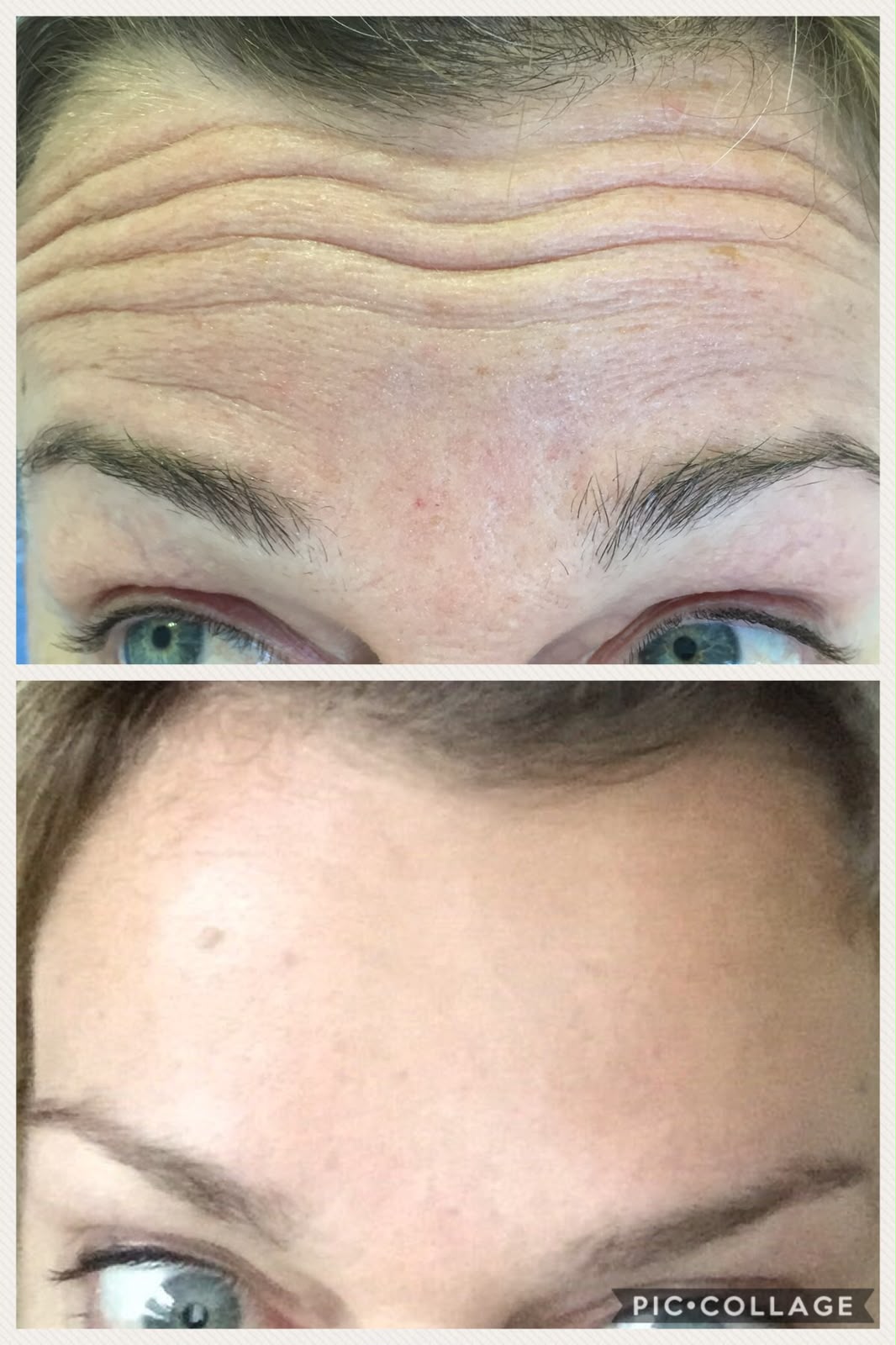 Antes e depois do botox, foto 1