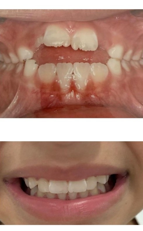 Antes e depois da ortodontia, foto 2